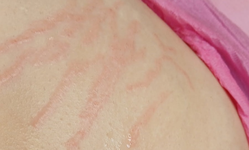 Image 3: Transform Your Skin with Targeted Stretch Mark Revision or Removal