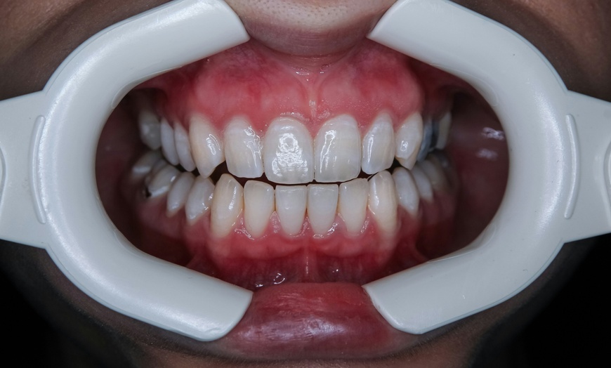 Image 7: Dental Exam, Teeth Whitening, Membership, X-ray/Implant Package & More