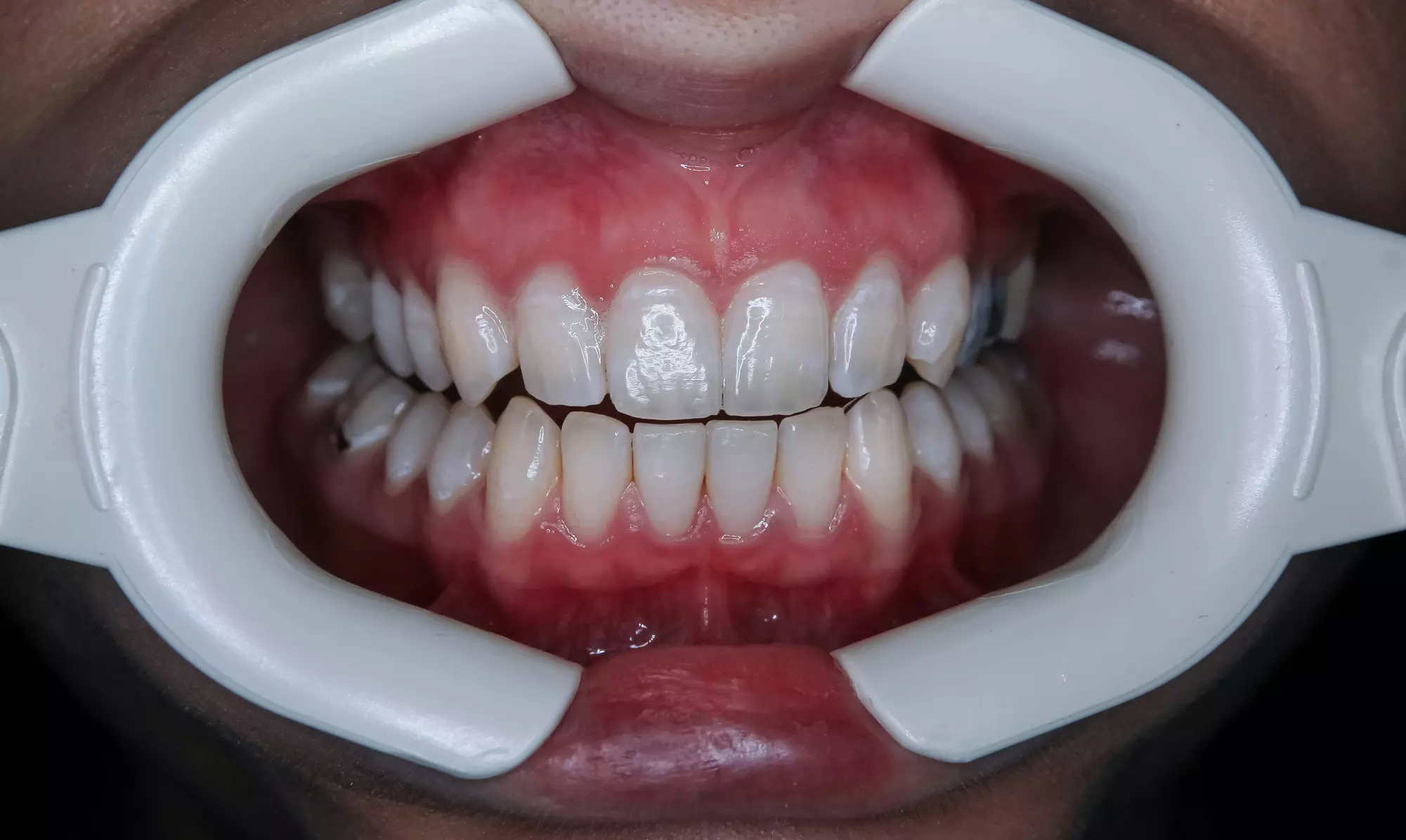 Dental Exam, Teeth Whitening, Membership, X-ray/Implant Package & More