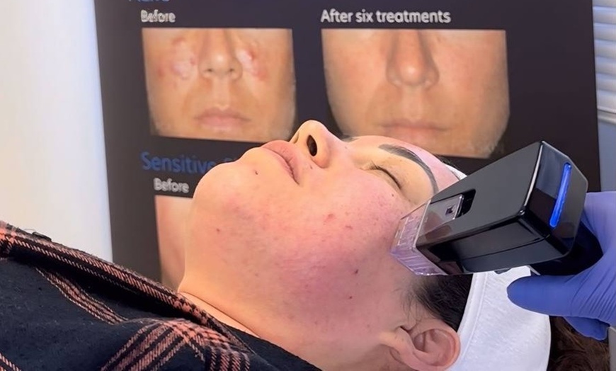 Image 4: Revitalize Your Face with RF Micro-Needling Session!
