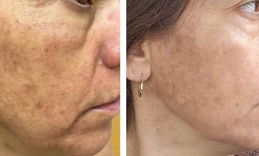 Image 3: Alma Opus Plasma Resurfacing for Wrinkles, Dark Spots & Skin Laxity