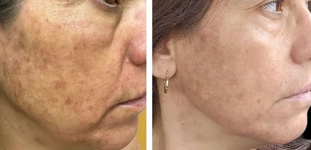 Alma Opus Plasma Resurfacing for Wrinkles, Dark Spots & Skin Laxity