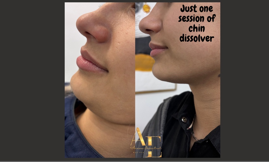 Image 3: Up to 51% Off on Fat Reduction at Arewa Essential Medspa