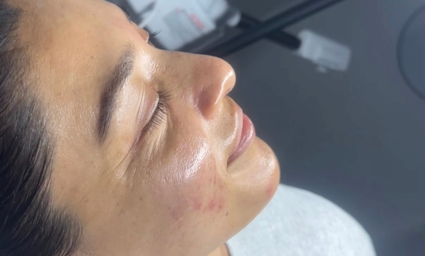 Image 2: One or Three Non-Surgical Face Lift: RF, Ultrasound & Cryo LED Facial 