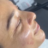 Image 2: Up to 30% Off on Facelift - Non-Surgical at Prasada skin