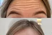 Up to 33% Off on Injection - Botox at Skinn Loft - Image 4