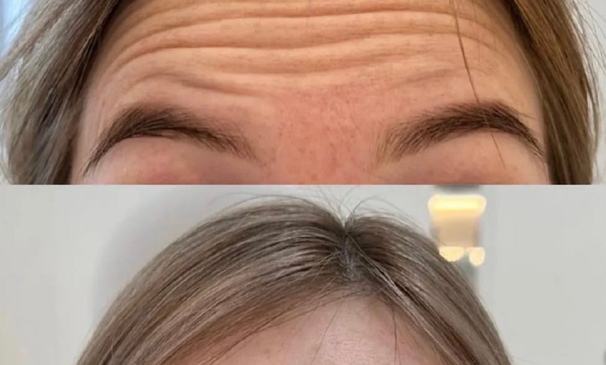 Image 4: Up to 40% Off on Injection - Botox at Skinn Loft