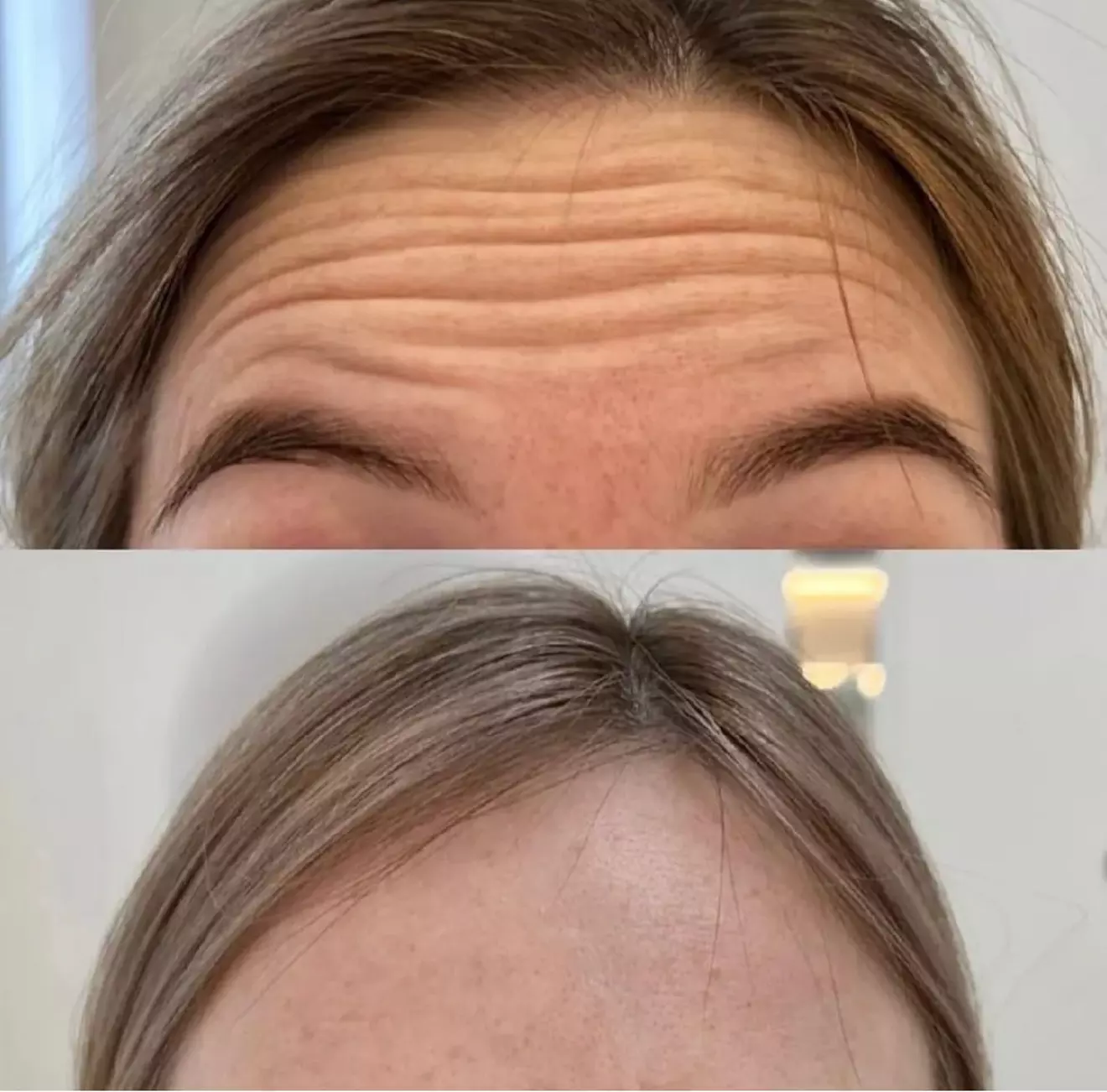 Up to 33% Off on Injection - Botox at Skinn Loft