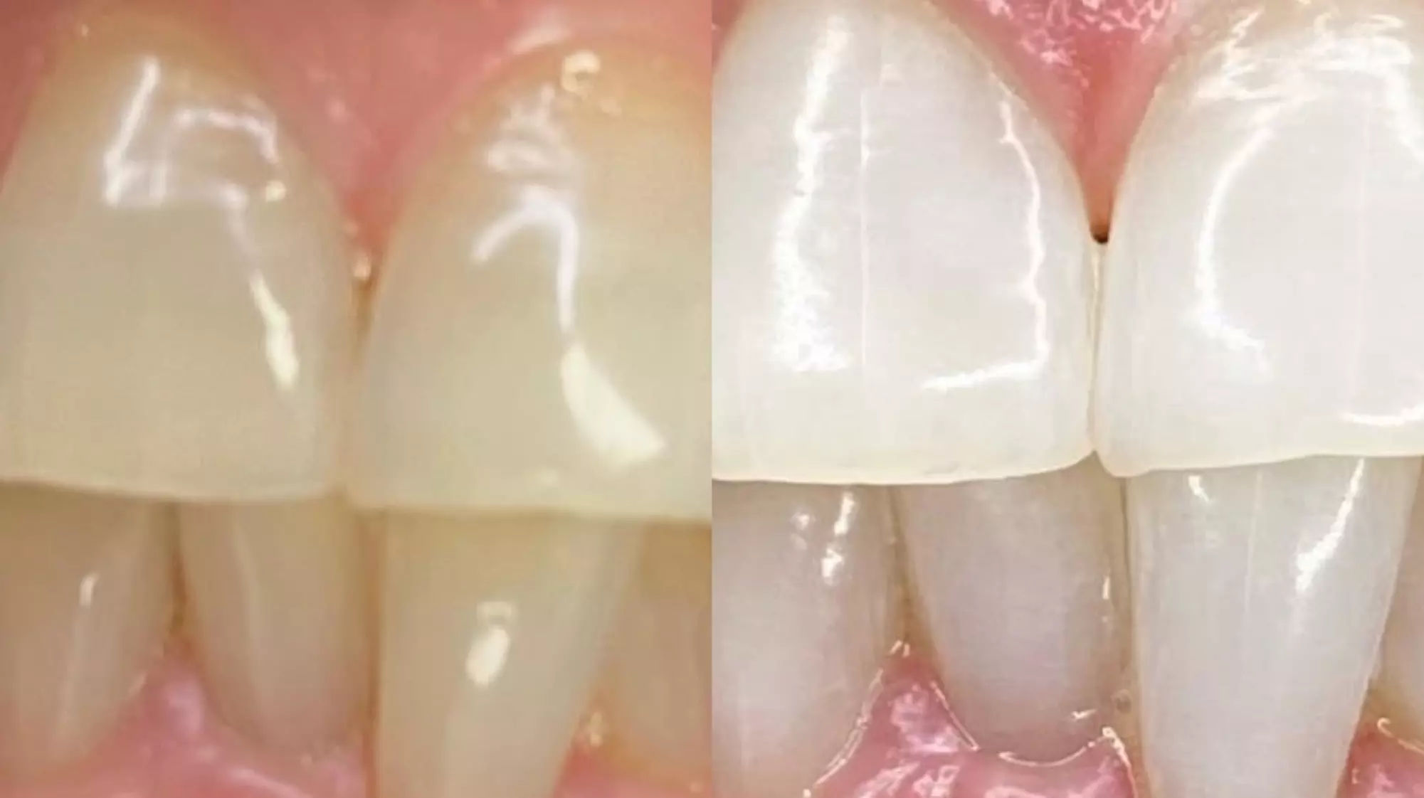 Get a Dazzling Smile with Express or Standard Teeth Whitening Session