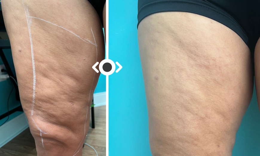 Image 2: Up to 39% Off on Radio Frequency Skin Tightening at Aesthetics Care Med Spa