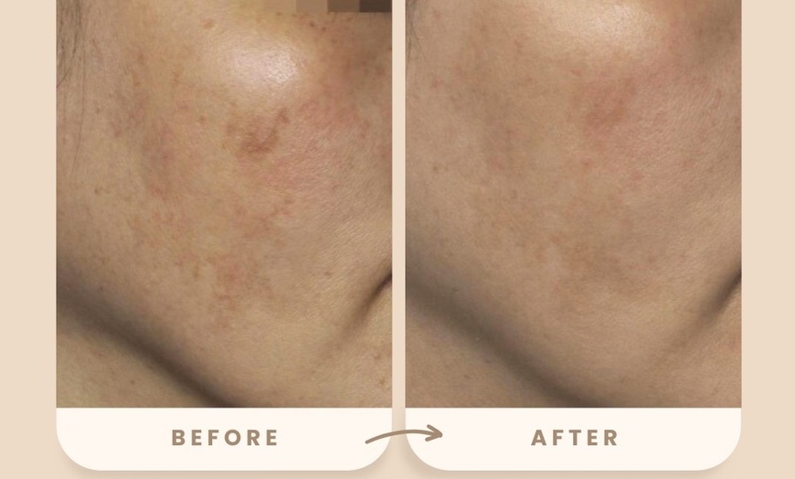 Image 4: Reverse Ageing & Repair Scars: Sylfirm X (One, Two, or Three Sessions)