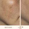 Image 4: Reverse Ageing & Repair Scars: Sylfirm X (One, Two, or Three Sessions)