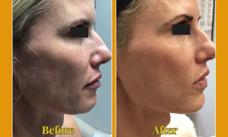 Image 3: Ultherapy Prime Treatment with for Face, Neck and Chest 