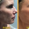 Image 3: Ultherapy Prime Treatment with for Face, Neck and Chest 