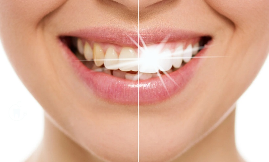 Image 1: Tanden bleken bij House of Maus Rotterdam 5 x 15 minuten