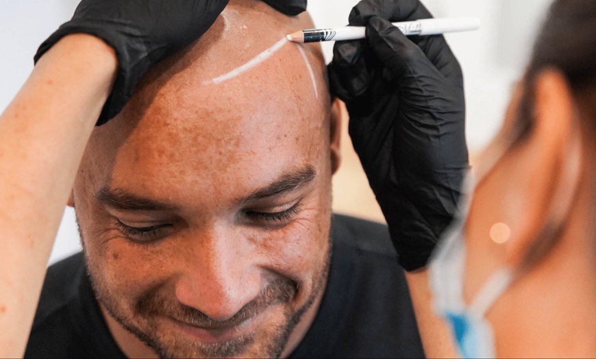 Image 2: Descuento en micropigmentación capilar para 1 persona