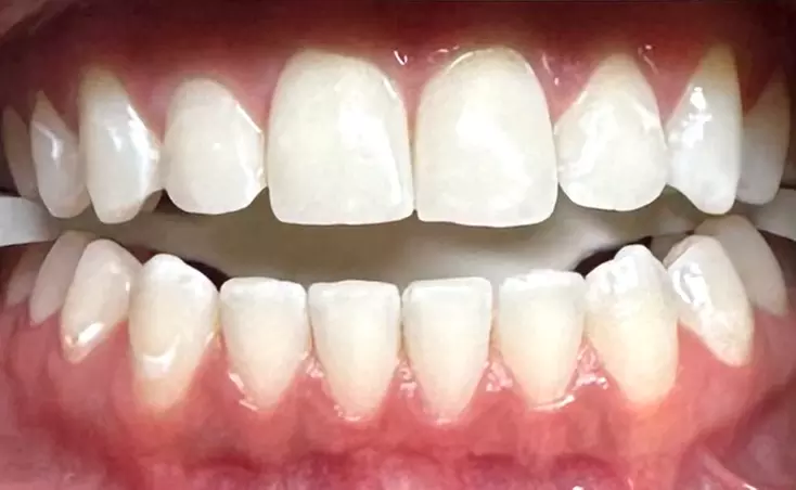 Up to 50% Off on Teeth Whitening - In-Office - Non-Branded at Vivid Smile Lab - Primary Image