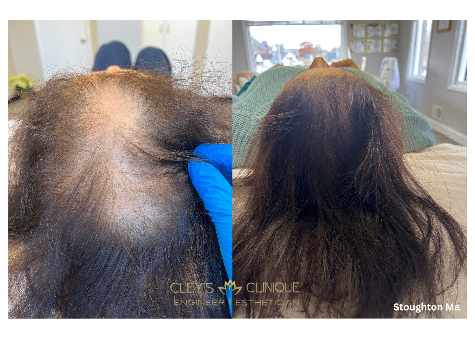 Revitalize Your Hair with 1 or 2 Hair Loss Microneedling Treatments