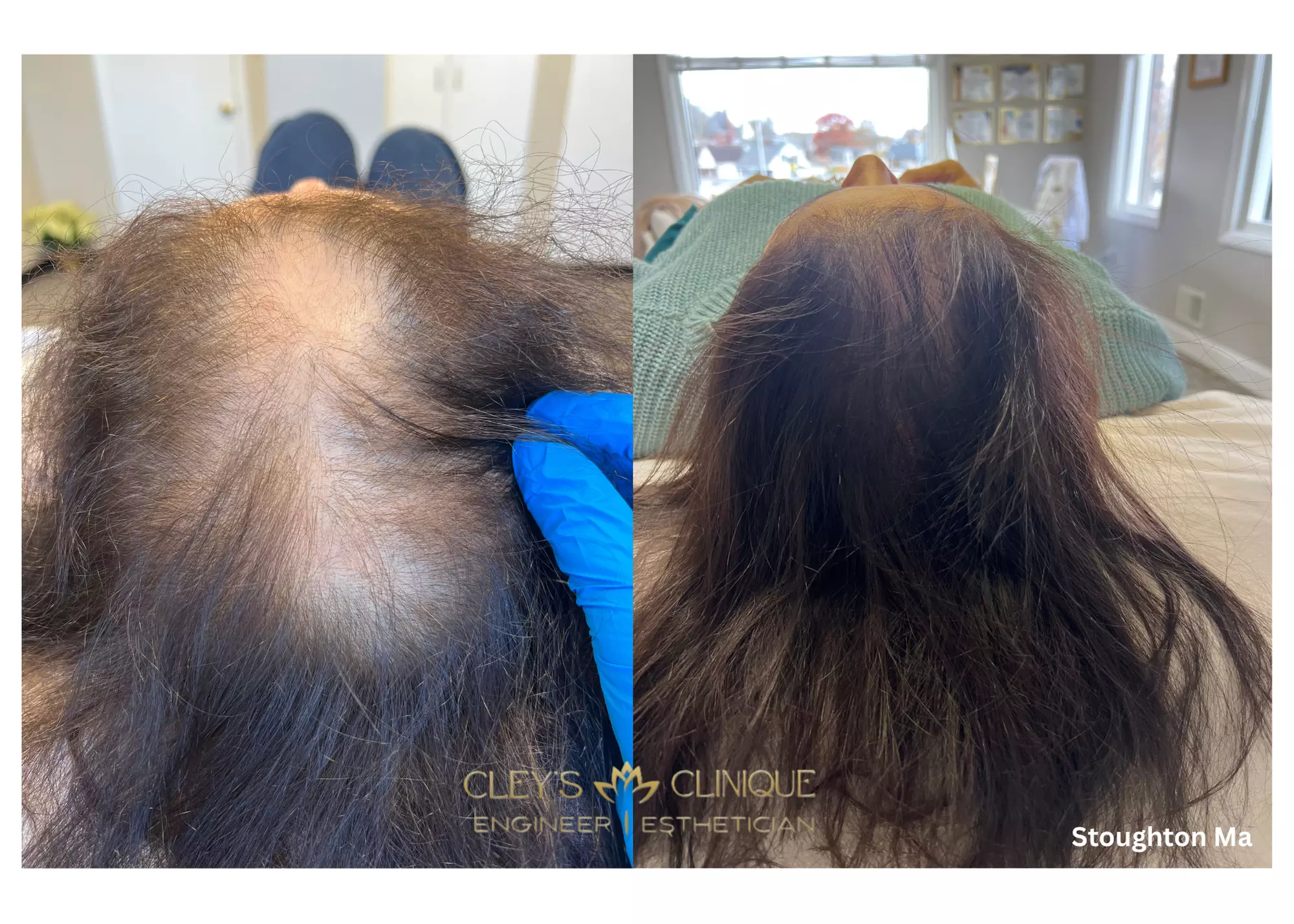 Revitalize Your Hair with 1 or 2 Hair Loss Microneedling Treatments