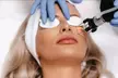 Get 1 CO2 Laser Skin Resurfacing For Acne Scars And Skin Tightening - Up to 74% Off - Second Medium
