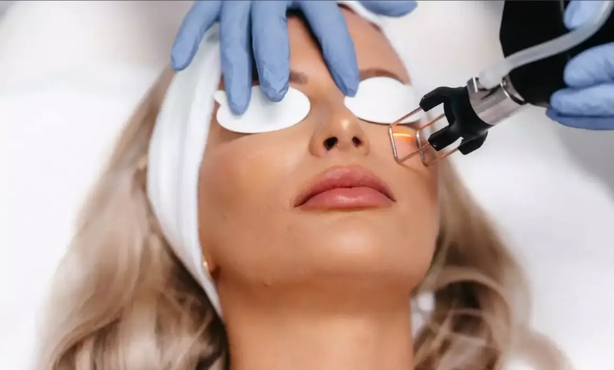 Image 5: 1 CO2 Laser Skin Resurfacing For Acne Scars And Skin Tightening