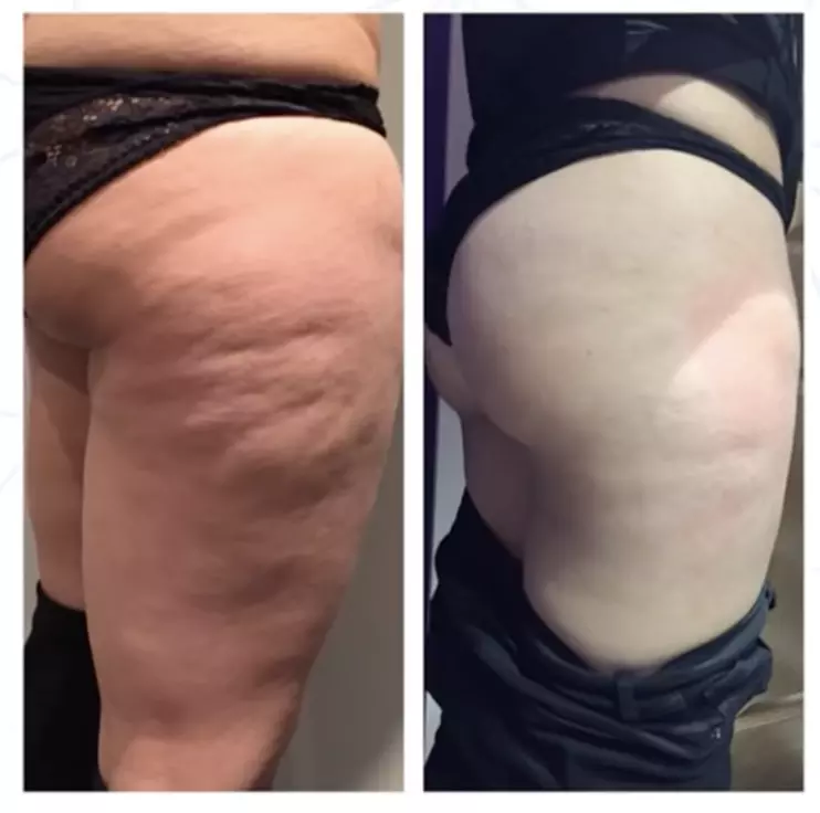Up to 30% Off on Lipo - Non-Invasive Laser-iLipo at Fahrenheit Clubs - Second Medium