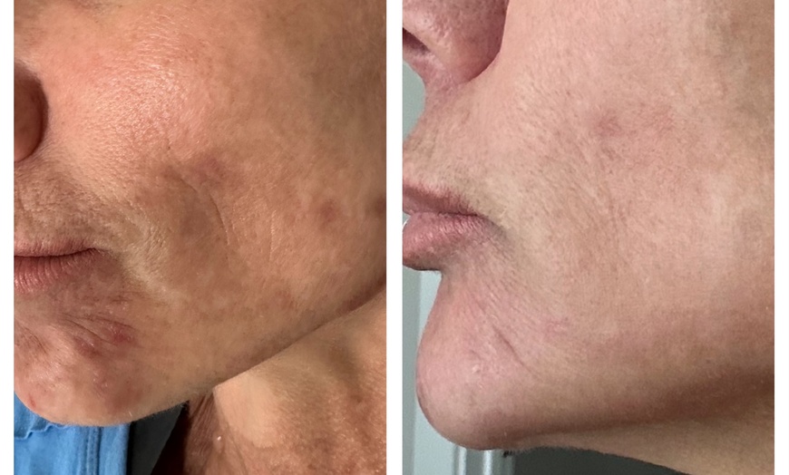 Image 9: Up to 55% Off on Laser Skin Resurfacing at Amora Med Spa