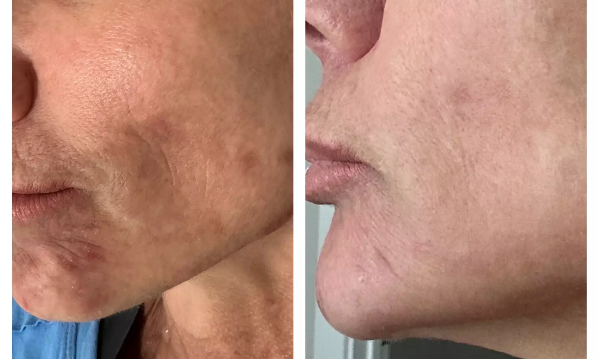 Up to 55% Off on Laser Skin Resurfacing at Amora Med Spa