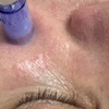 Image 1: One or Two Microneedling Treatments with Hyaluornic Acid and More