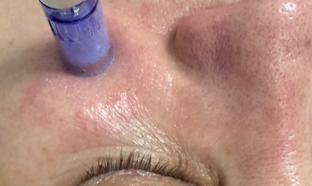 One 60 Minute Glow Facial with TCA Chemical Peel - Skin Couture NY
