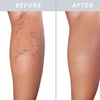 Image 2: Effective Spider Vein Removal with Sclerotherapy & Leg Vein Ultrasound