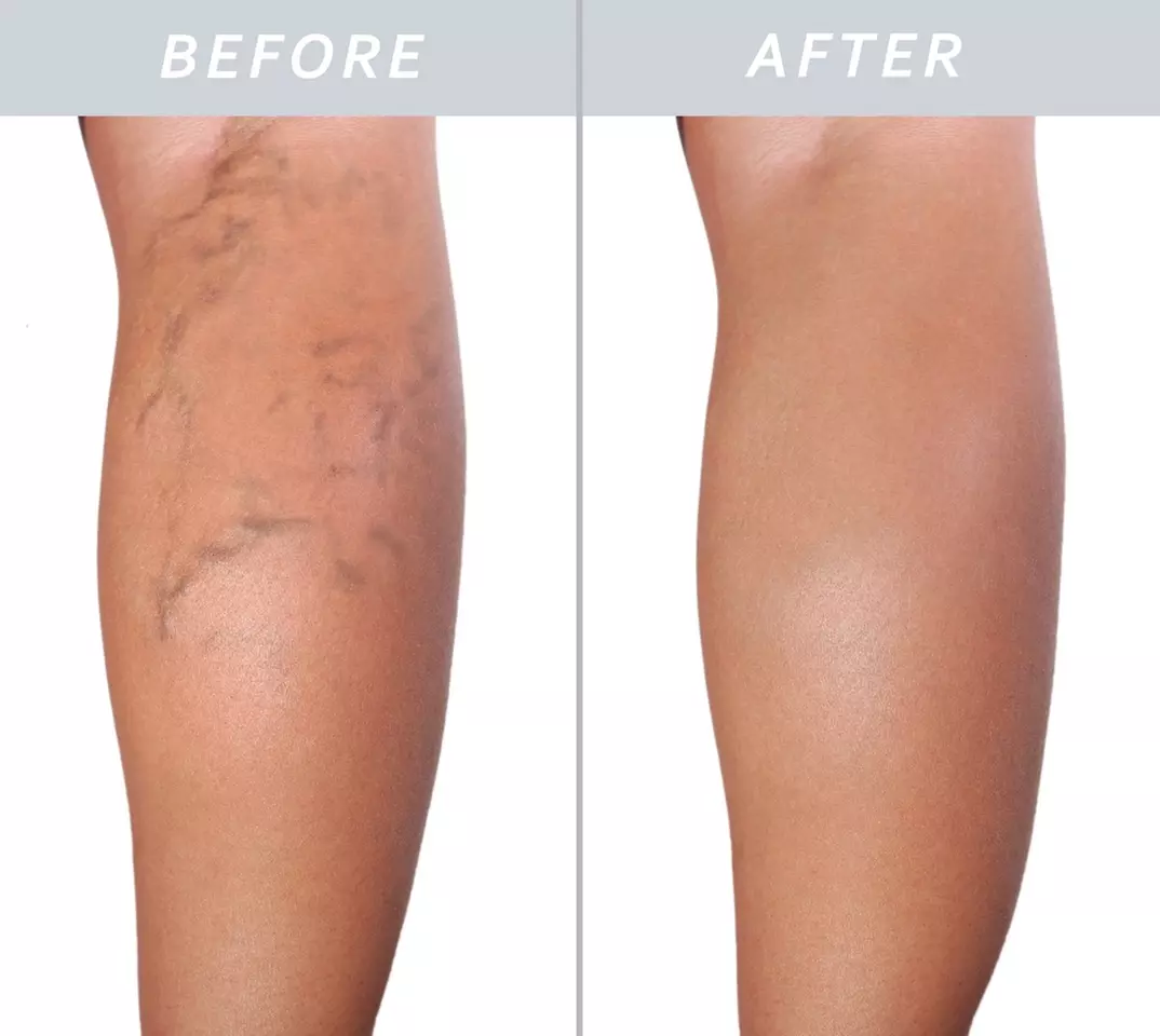 Effective Spider Vein Removal with Sclerotherapy & Leg Vein Ultrasound