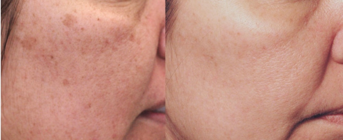 Up to 60% Off on Mole / Growth Removal at Wicked aesthetics