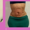 Image 2: Get Total Body Sculpt, Peach Perfection, / Mommy Makeover Glow Package 