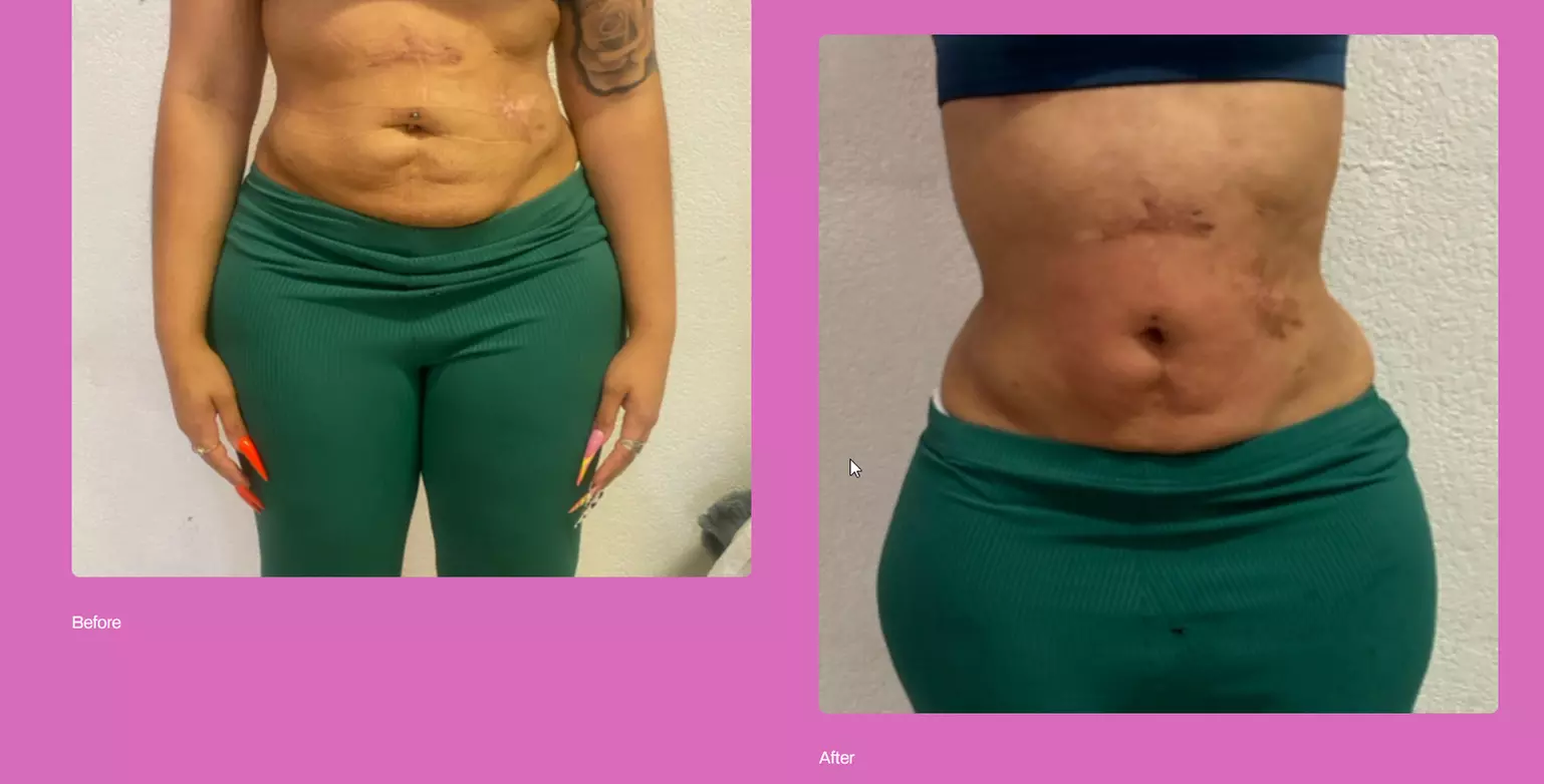 Get Total Body Sculpt, Peach Perfection, / Mommy Makeover Glow Package