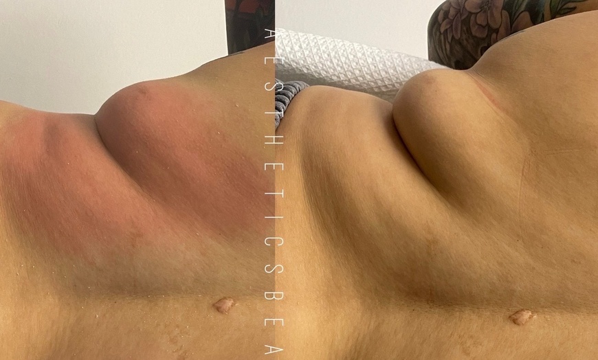 Image 4: Up to 84% Off on Lipo - Non-Invasive Laser-iLipo at Aesthetics Beauty Laser