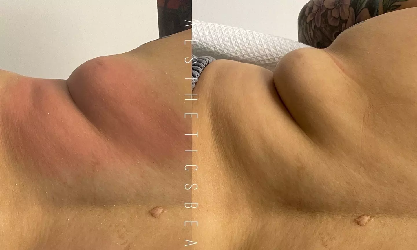 Up to 85% Off on Lipo - Non-Invasive Laser-iLipo at Aesthetics Beauty Laser