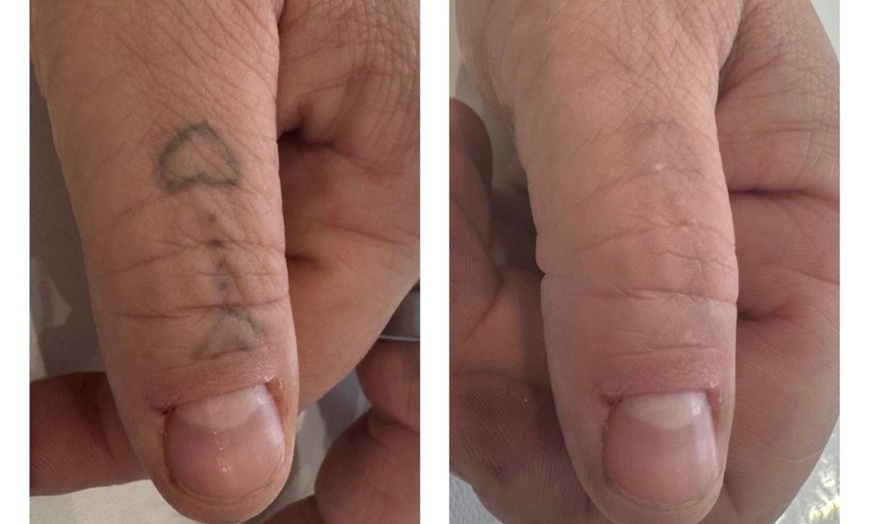Image 3: Up to 68% Off on Tattoo Removal at HL Lasers