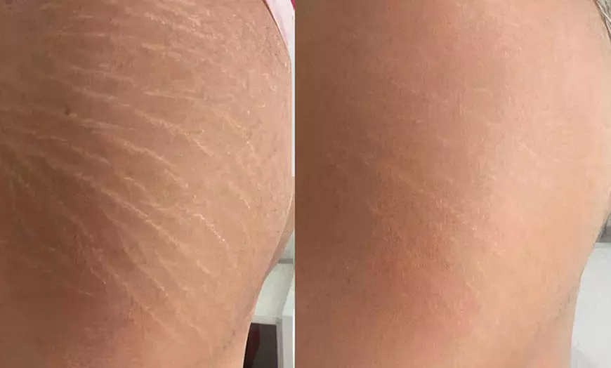 Image 1: Stretch marks treatment with Optional One Plasma Fibroblast & More