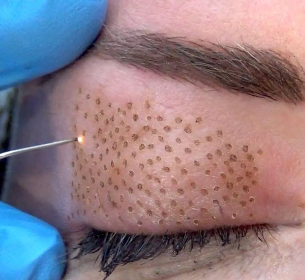 Plasma pen para blefaroplastia, patas de gallo, abdomen o verrugas