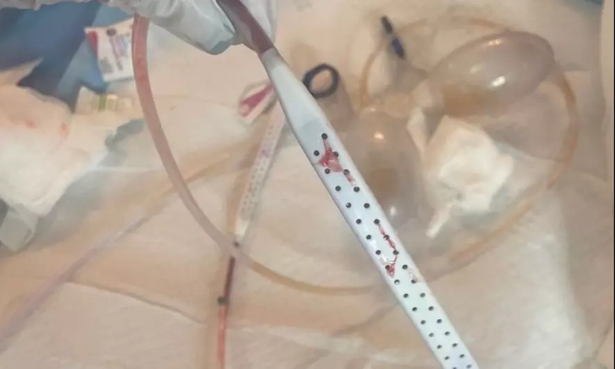 Post Op Drainage Treatments for Healing and Comfort