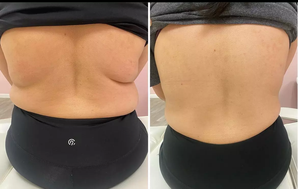 Fat Dissolver Liquid Lipo at Beauty By Bear