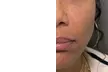 Enhance Your Looks with Juvederm Cheek Filler at River Oaks Galleria Medspa (Up to 45% Off) - Second Medium