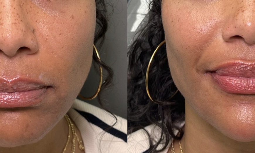 Image 2: Enhance Your Looks with Juvederm Cheek Filler
