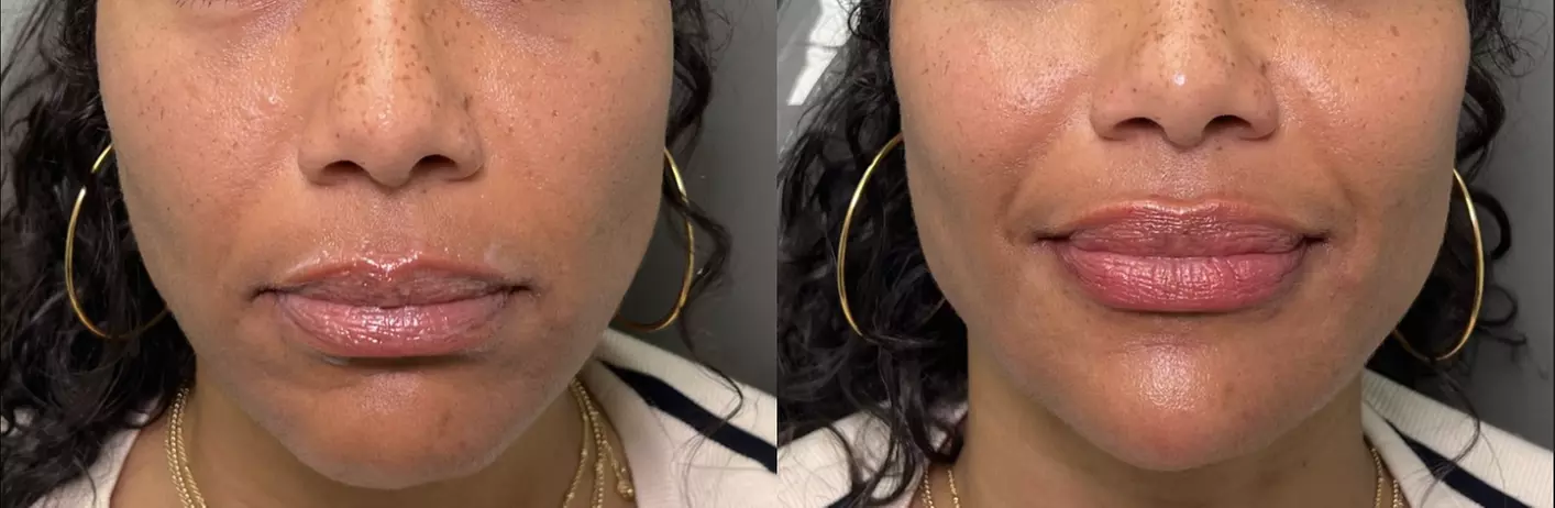 Enhance Your Looks with Juvederm Cheek Filler