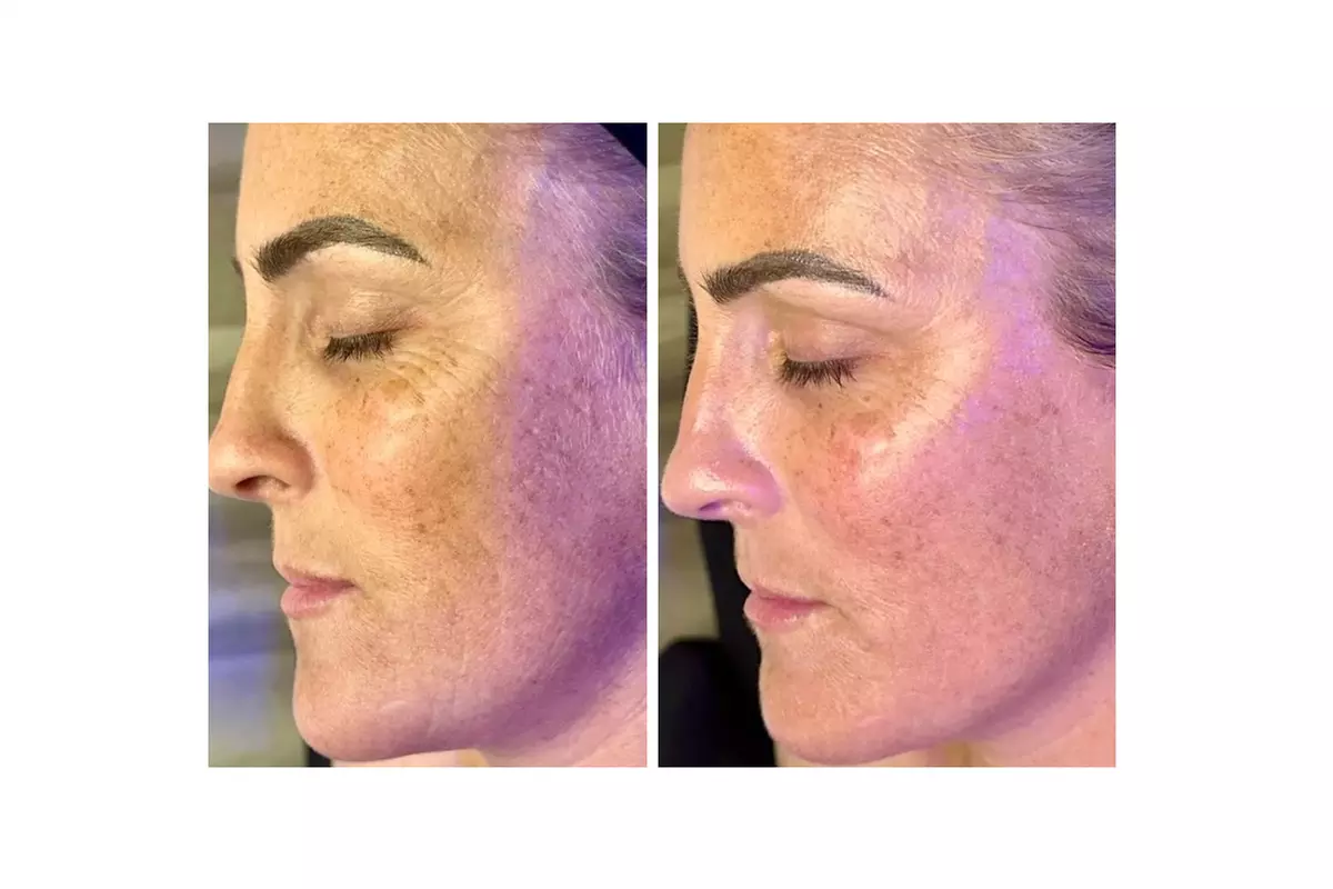 Turn Back Time with the Power of BioRePeel at Rise Skin Spa