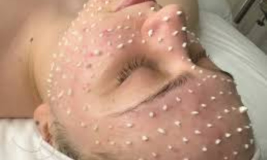 Image 1: Liquid Microneedle Treatment with Optional Stem Cell Booster Session