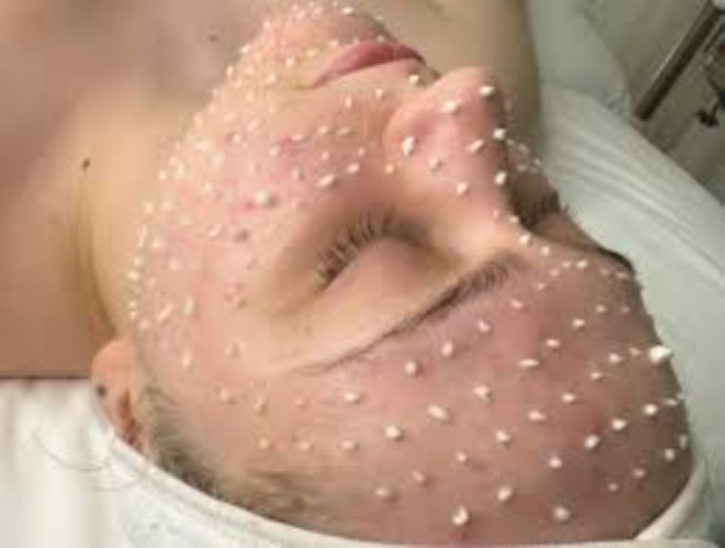 Liquid Microneedle Treatment with Optional Stem Cell Booster Session