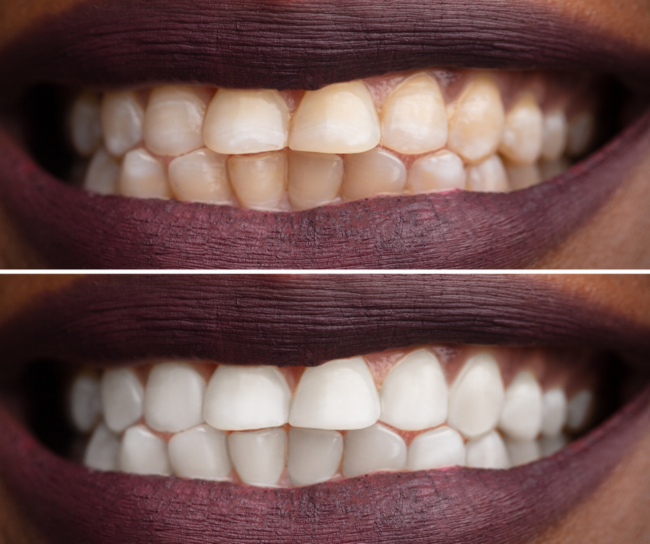 Brighten Your Smile with Advanced Teeth Whitening Sessions