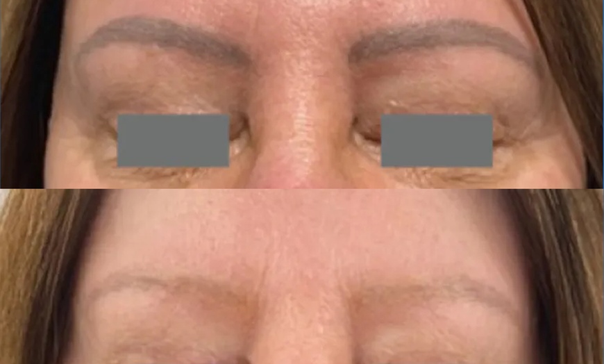 Image 7: Up to 30% Off on Tattoo Removal at Clarity Tattoo Removal